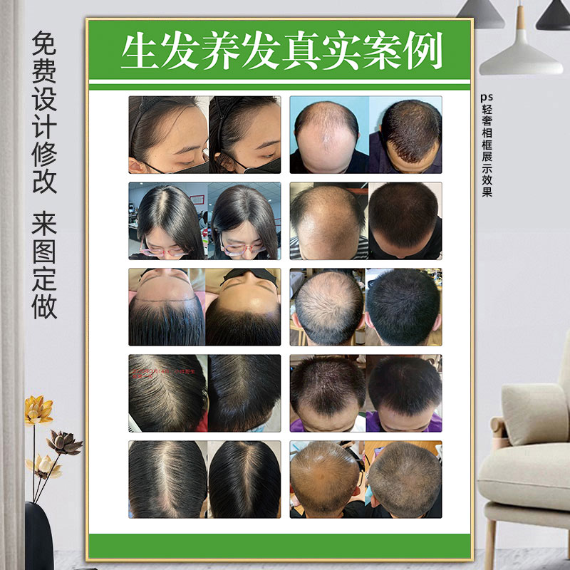 头皮检测对照图海报挂画养发生发对比图头皮问题护理广告脱发等级