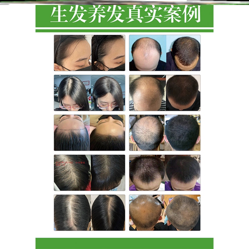 头皮检测对照图海报挂画养发生发对比图头皮问题护理广告脱发等级