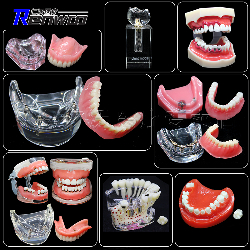 牙科模型 活动牙模型 吸附性义齿 种植杆卡 口腔牙模型 全口假牙