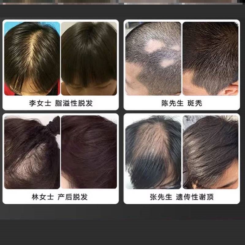 控油育发液脂溢性脱发日本品牌生姜育发液防脱生发增加发量神器